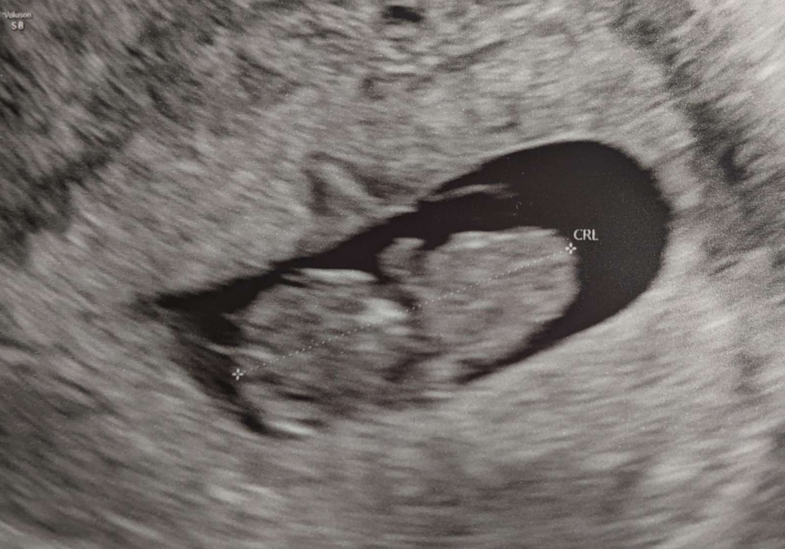 Ultrasound